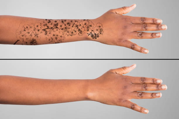 Melbourne's laser tattoo removal treatments