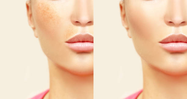 Before and after comparison of skin with pigmentation and clear skin treatment results