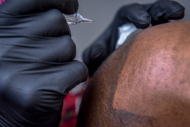 Why Is Scalp Micropigmentation Expensive? Understanding the Costs and Benefits