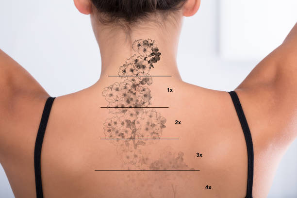 Laser Tattoo Removal Explained: Process, Effectiveness, and Alternatives