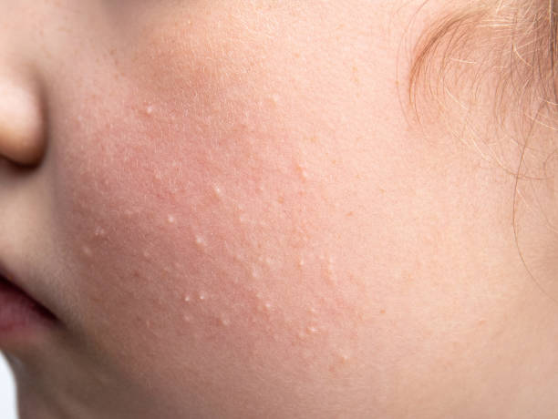 Close-up of a child's cheek showing mild acne and skin texture