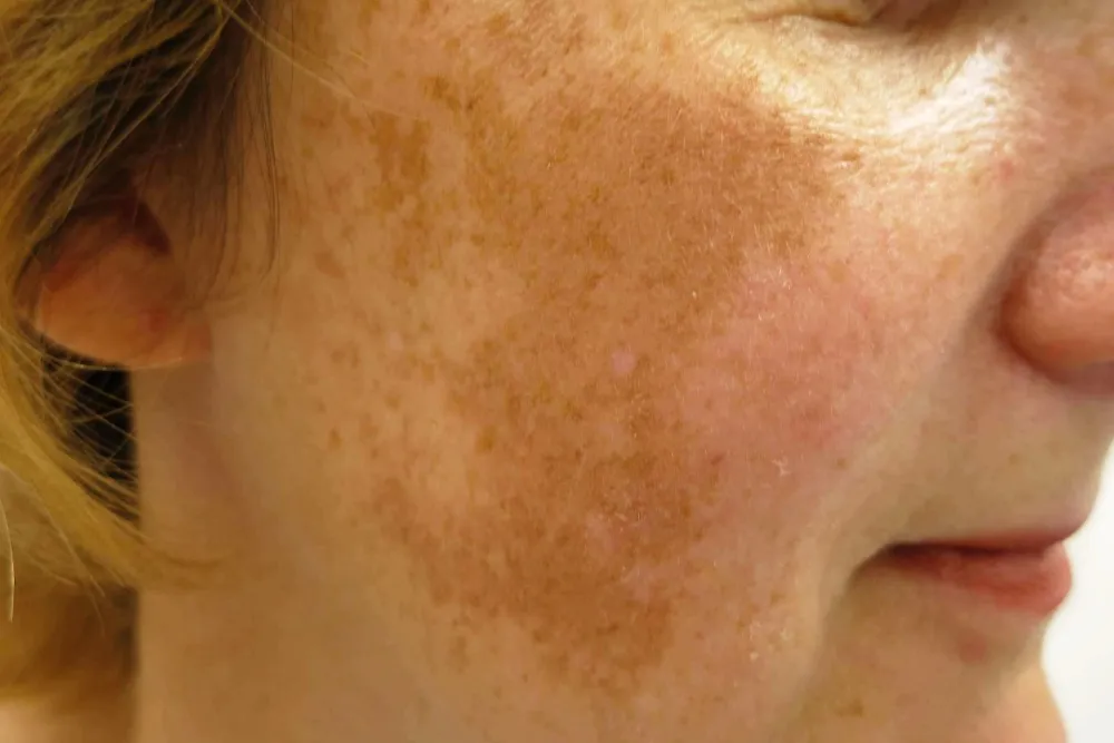 Effective Approaches to Prevent and Treat Hyperpigmentation Post-Microneedling