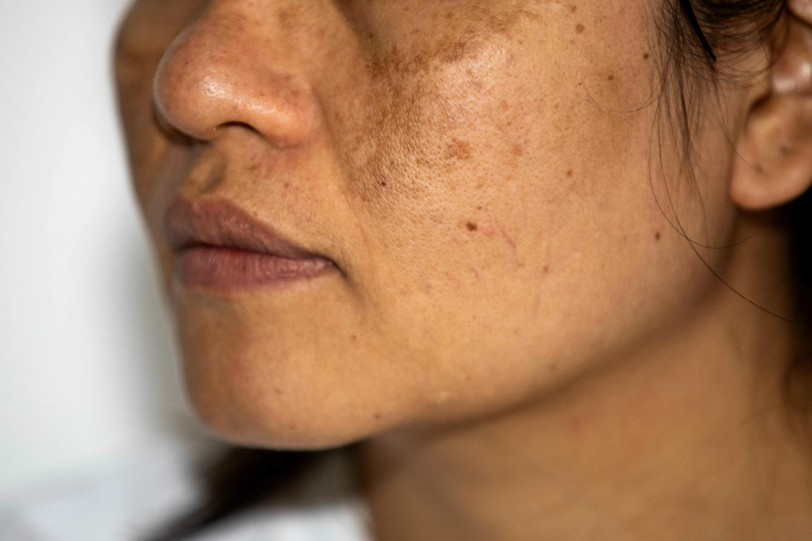 Natural remedies for post-microneedling hyperpigmentation treatment